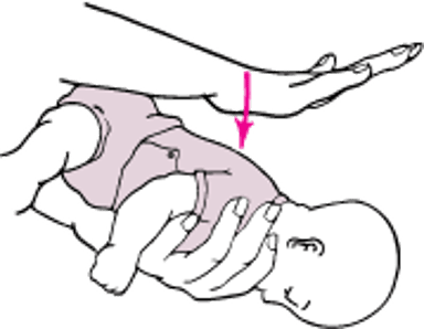 背部叩打法―乳児