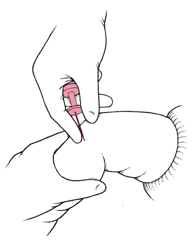 Intraosseous (IO) needle insertion
