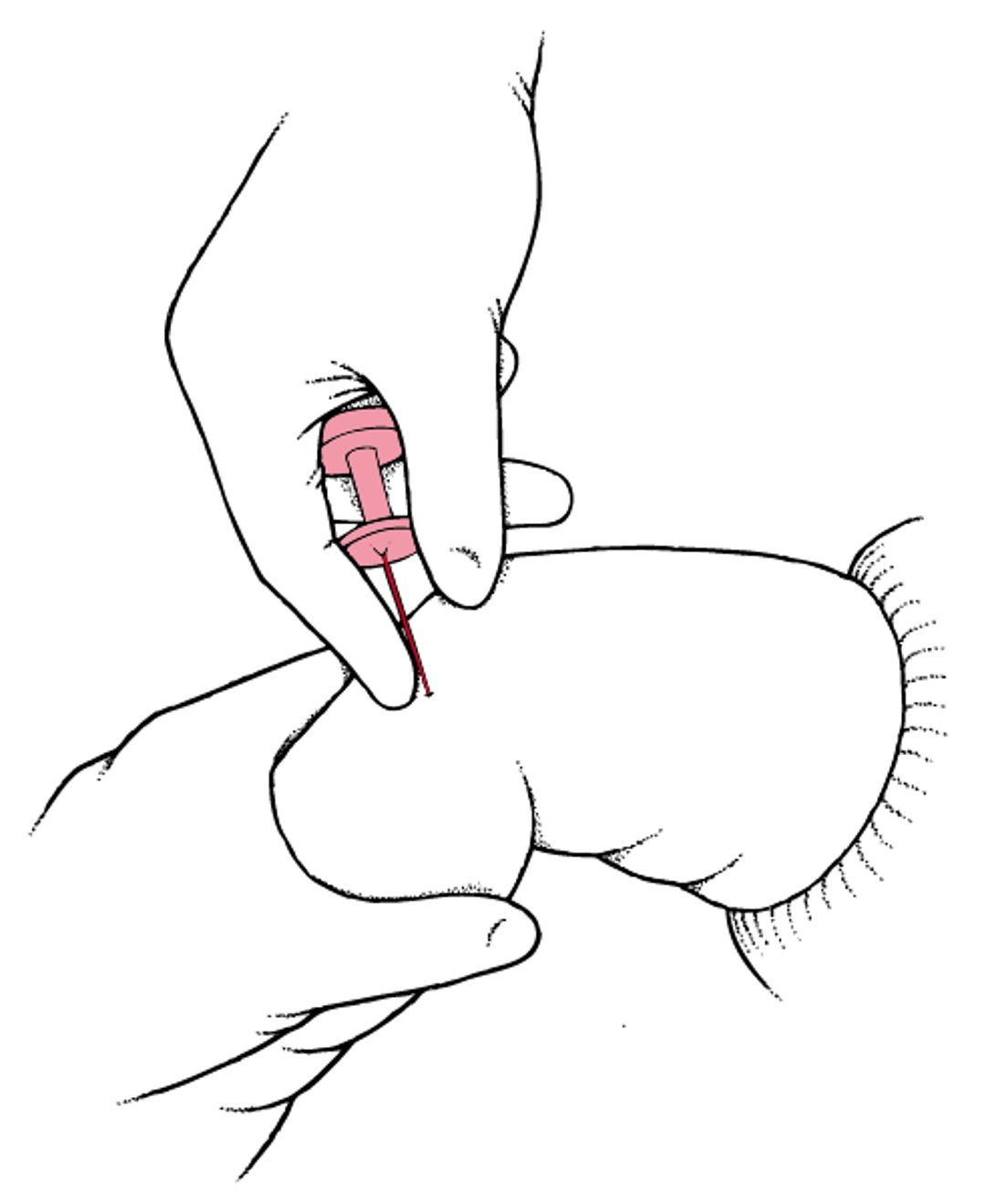 Inserção intraóssea (IO) de agulha