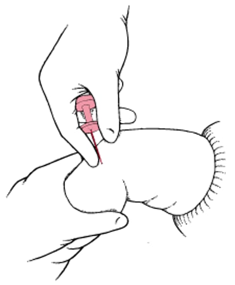Đặt kim truyền trong xương (IO)