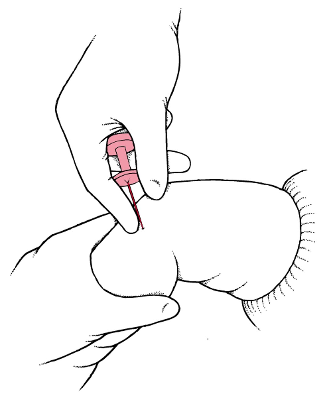 骨髓腔（IO）穿刺针插入
