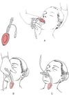 Laryngeal Mask Airway (LMA)