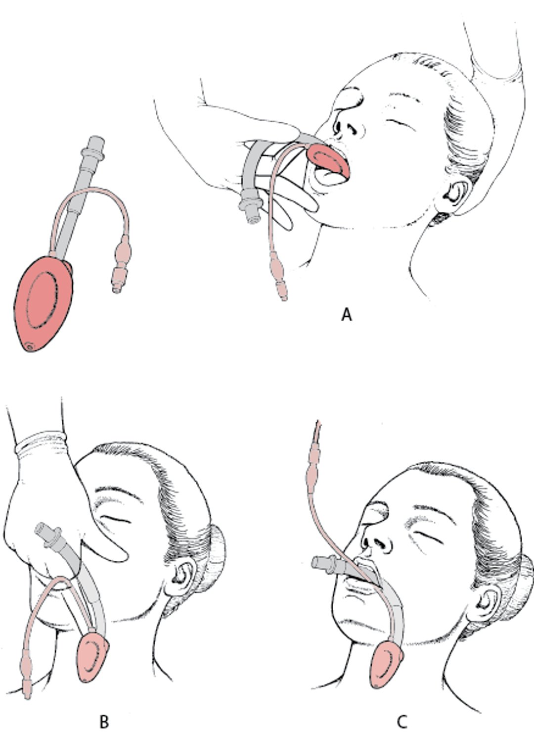 Masque laryngé des voies respiratoires