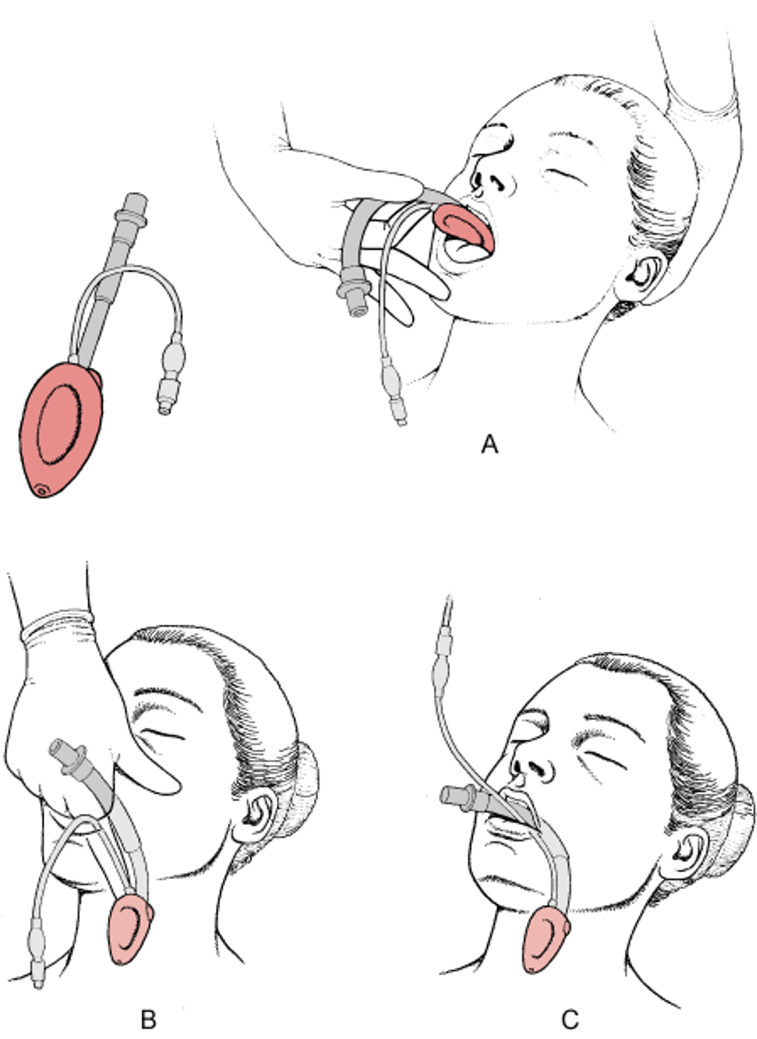 ラリンジアルマスク（LMA）