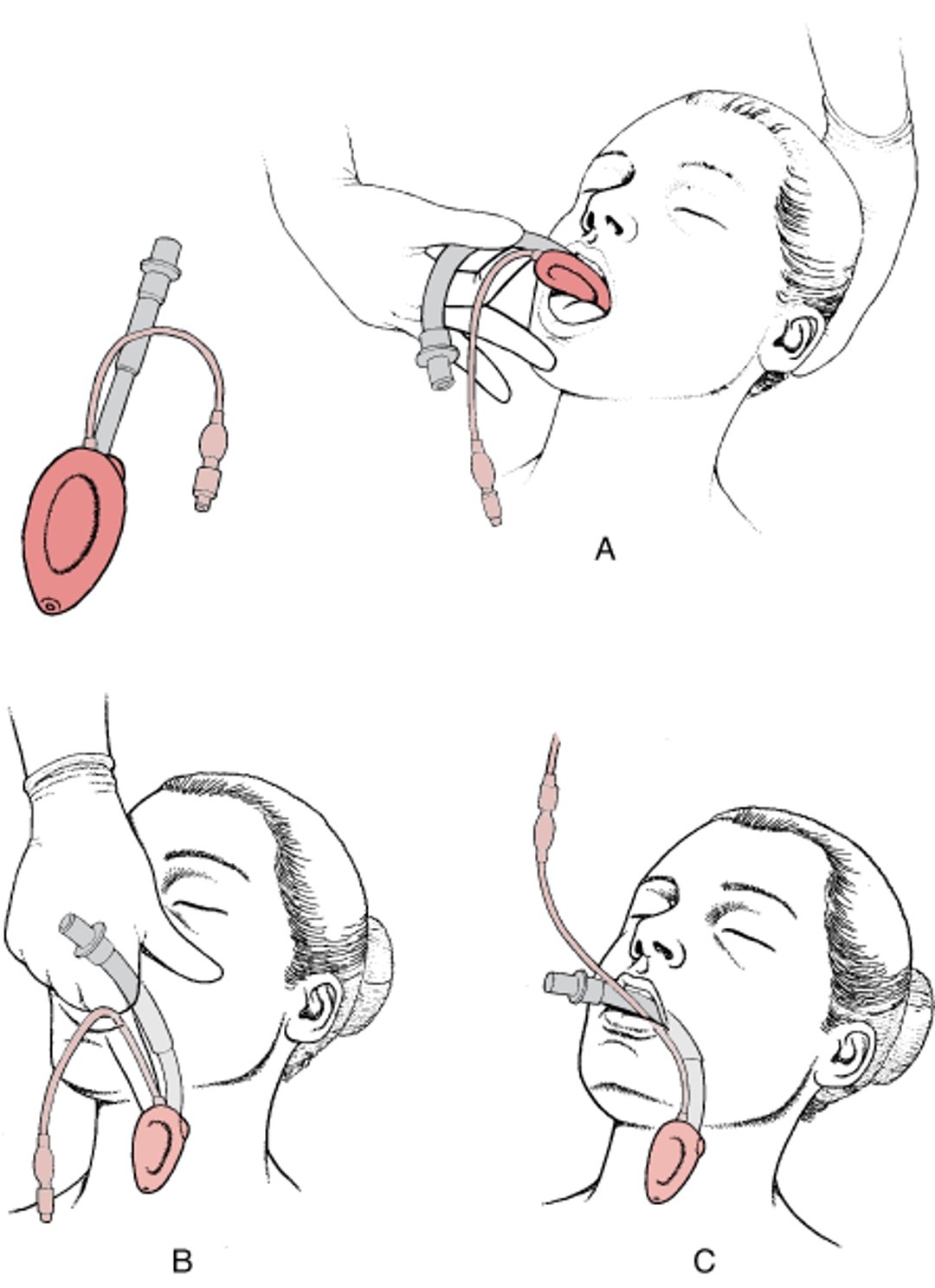 Гортанные дыхательные маски (laryngea mask airways LMA)