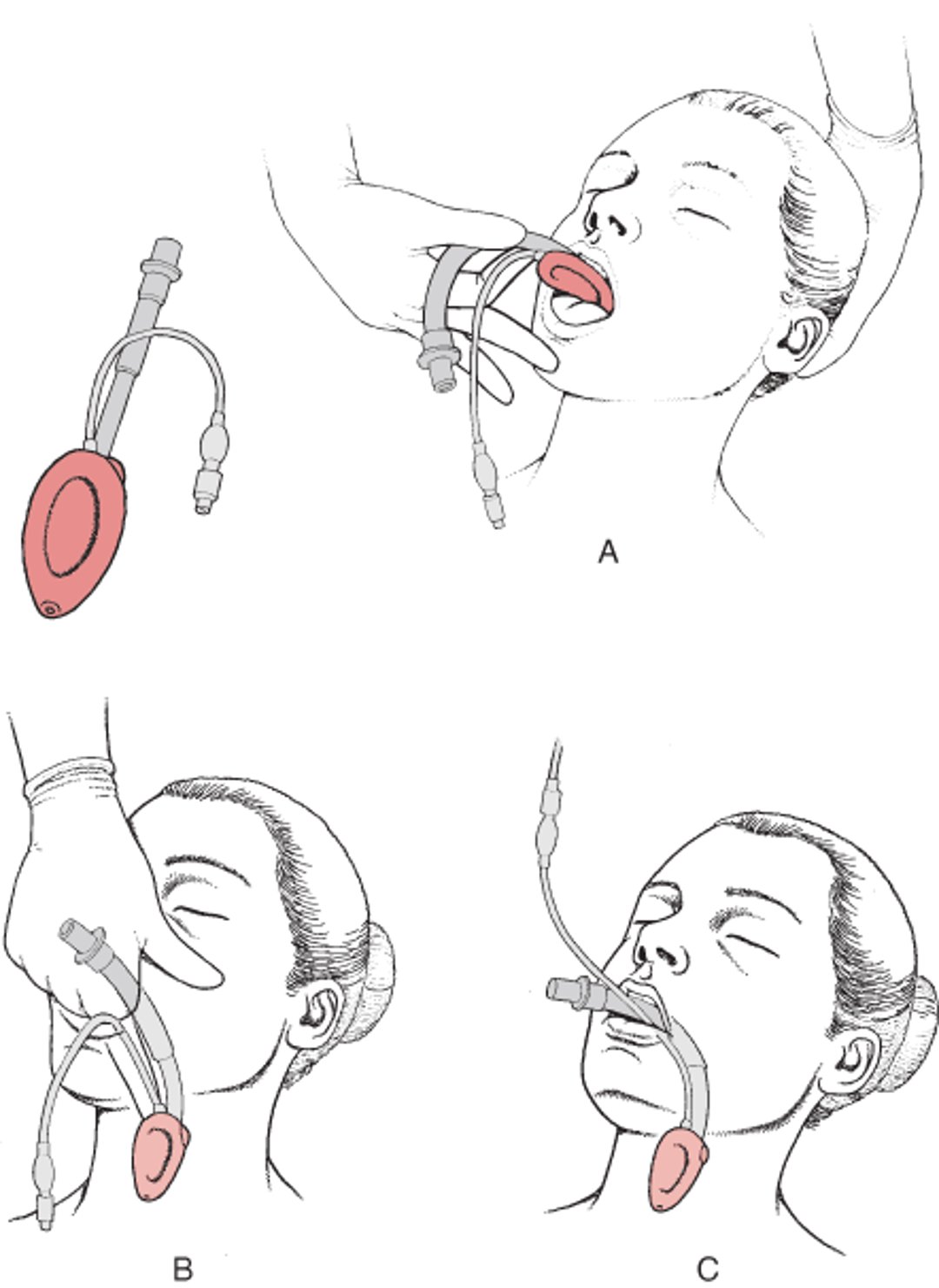 Ларингеальна маска (LMA)