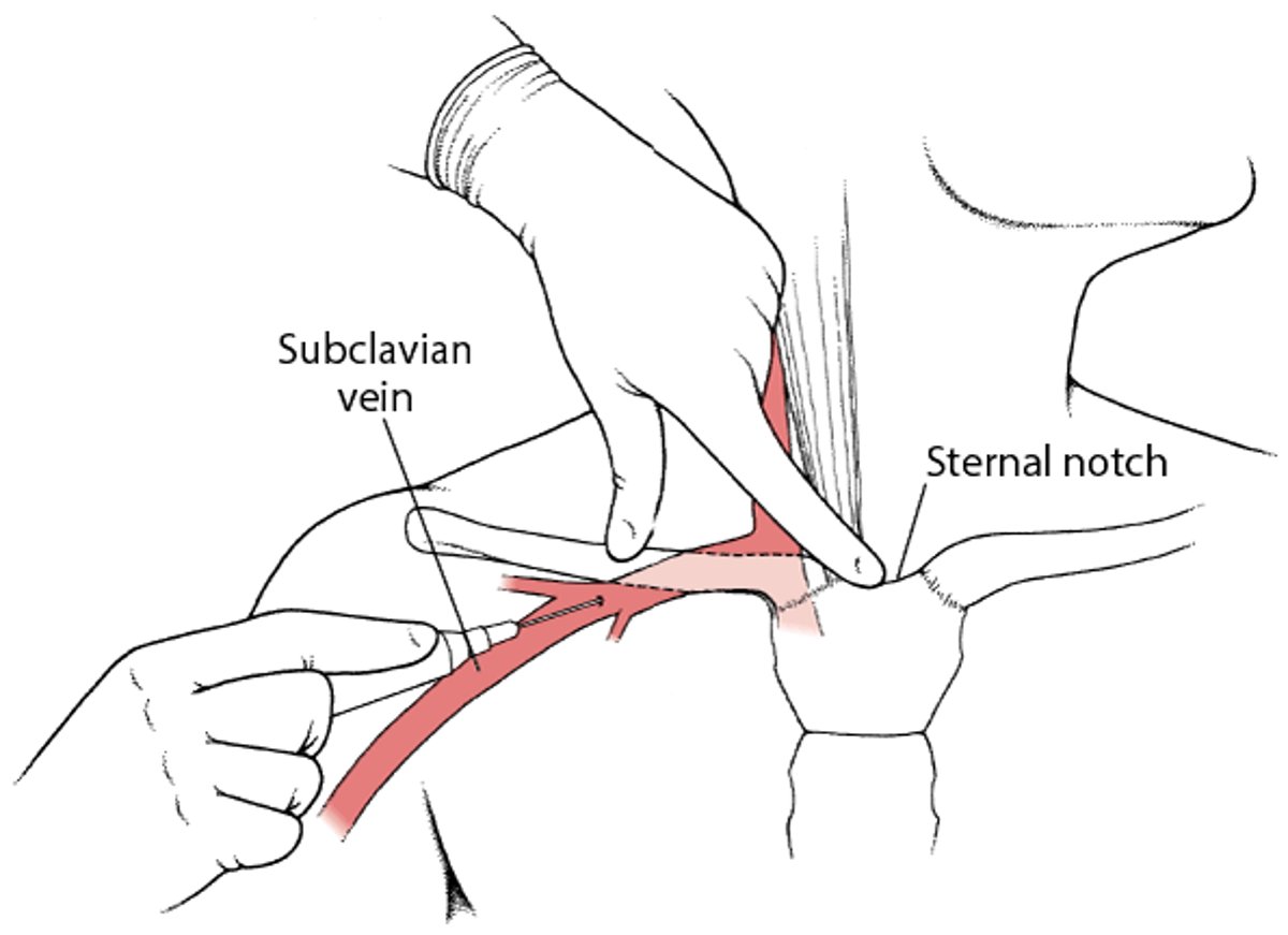 Subclavian venipuncture