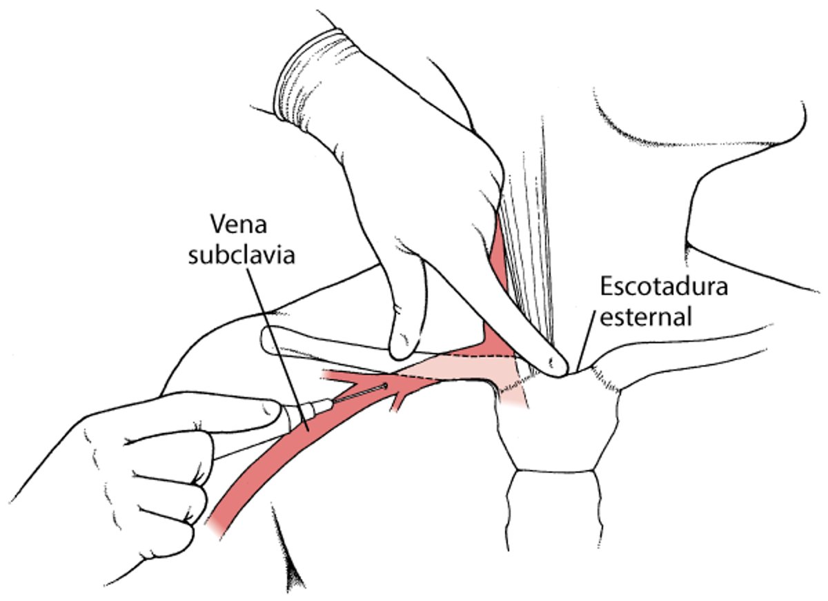Venopunción subclavia