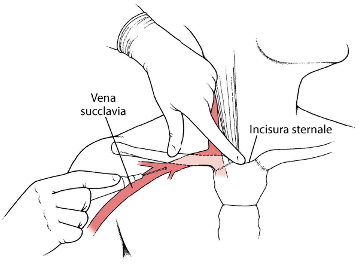 Venipuntura succlavia