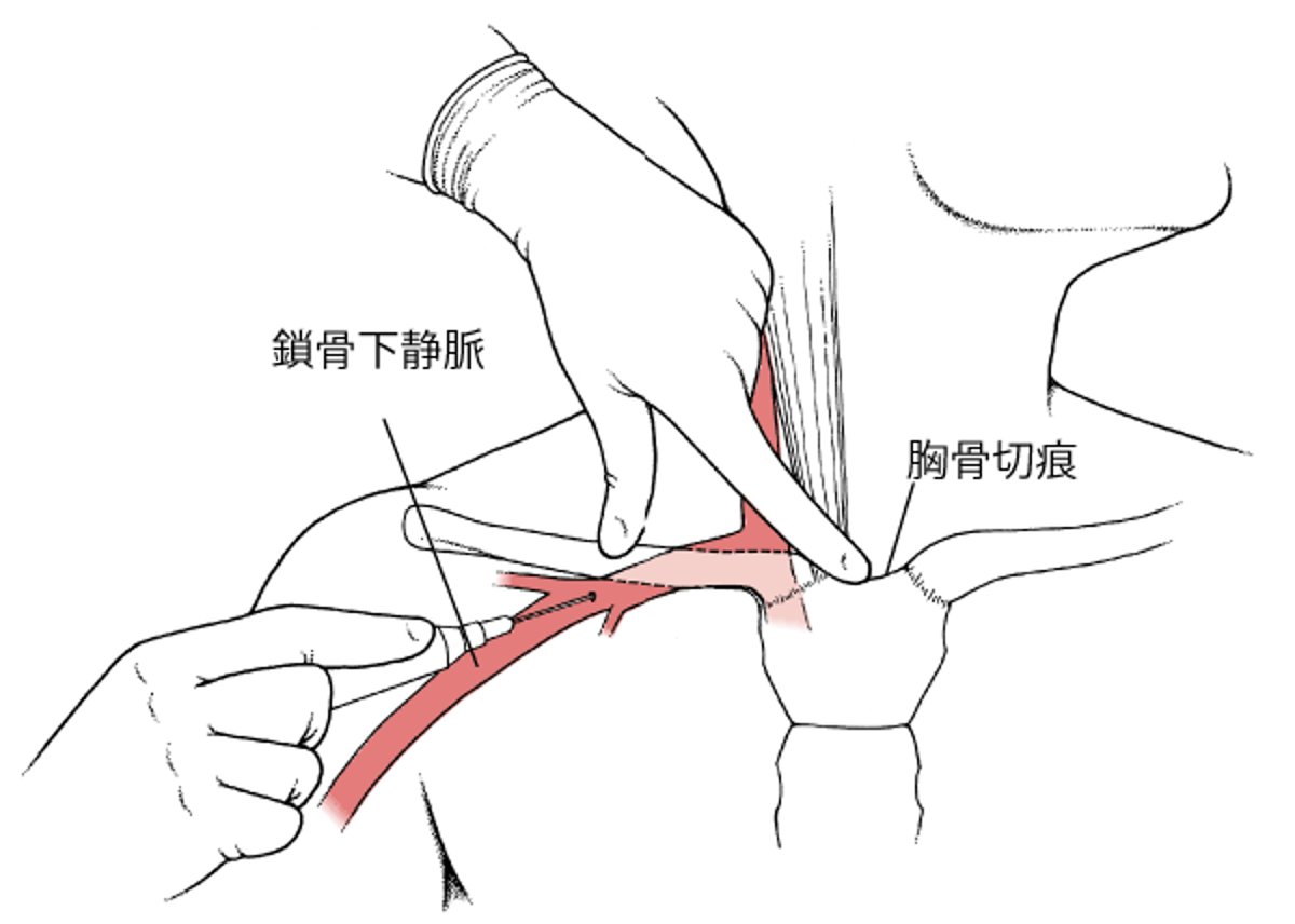 鎖骨下静脈穿刺