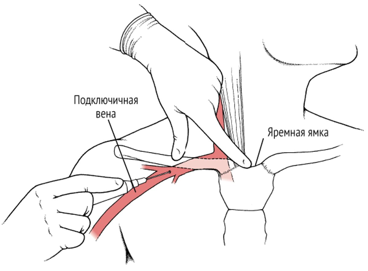 Подключичная венепункция