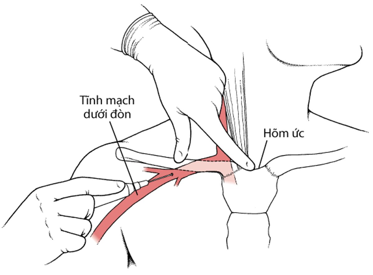 Chọc tĩnh mạch dưới đòn