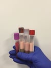Plasma "cremoso" debido a hipertrigliceridemia grave