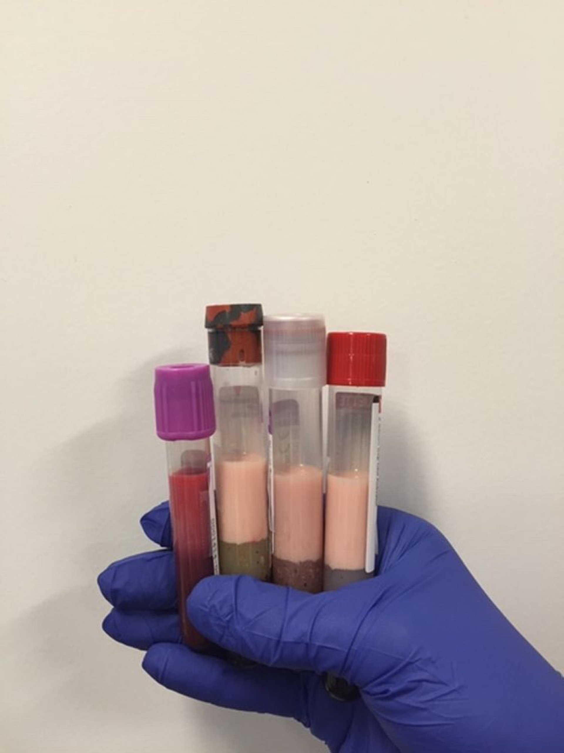 Plasma crémeux dû à une hypertriglycéridémie sévère