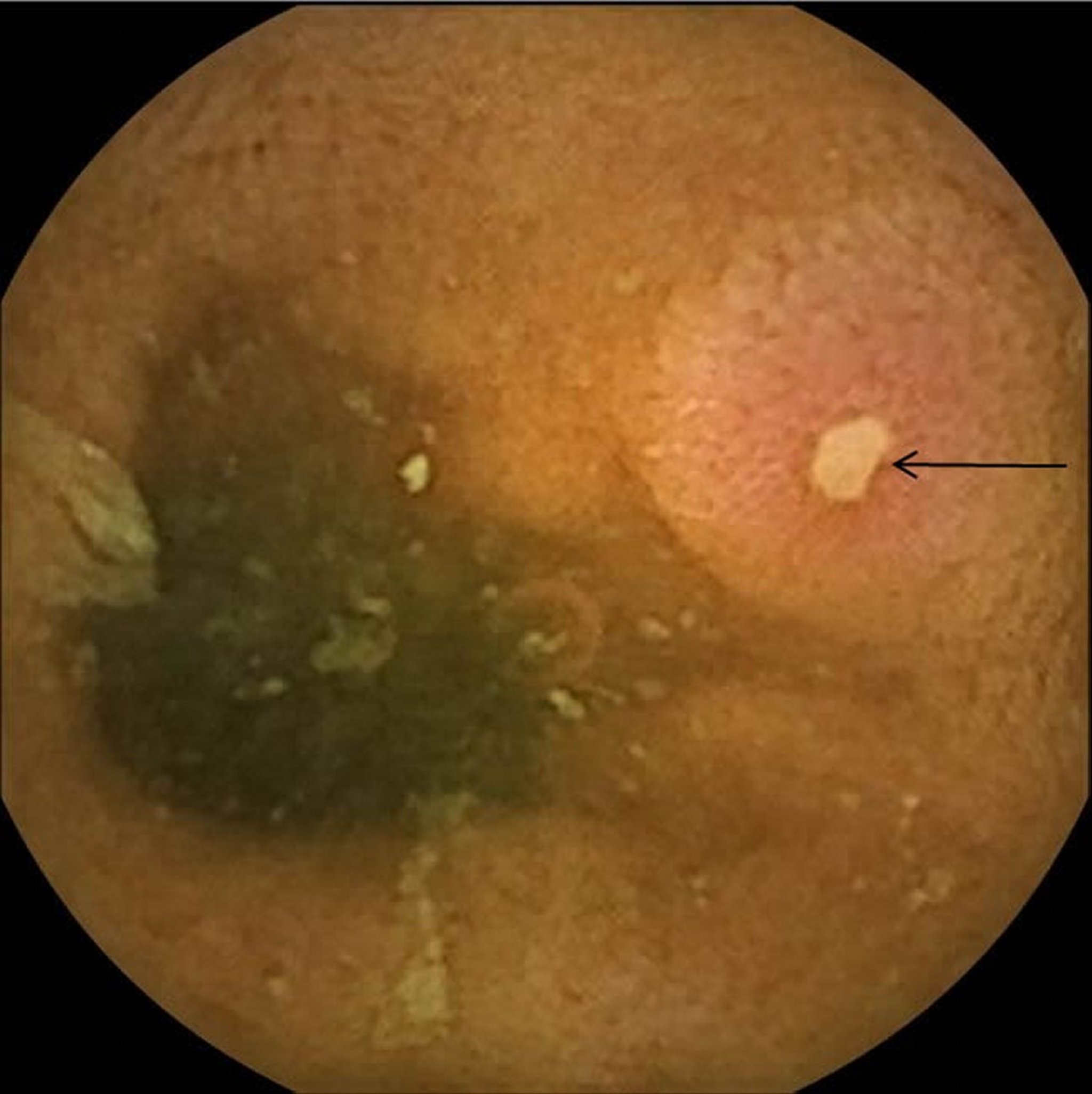 Ulcer of the Ileum in Crohn Disease