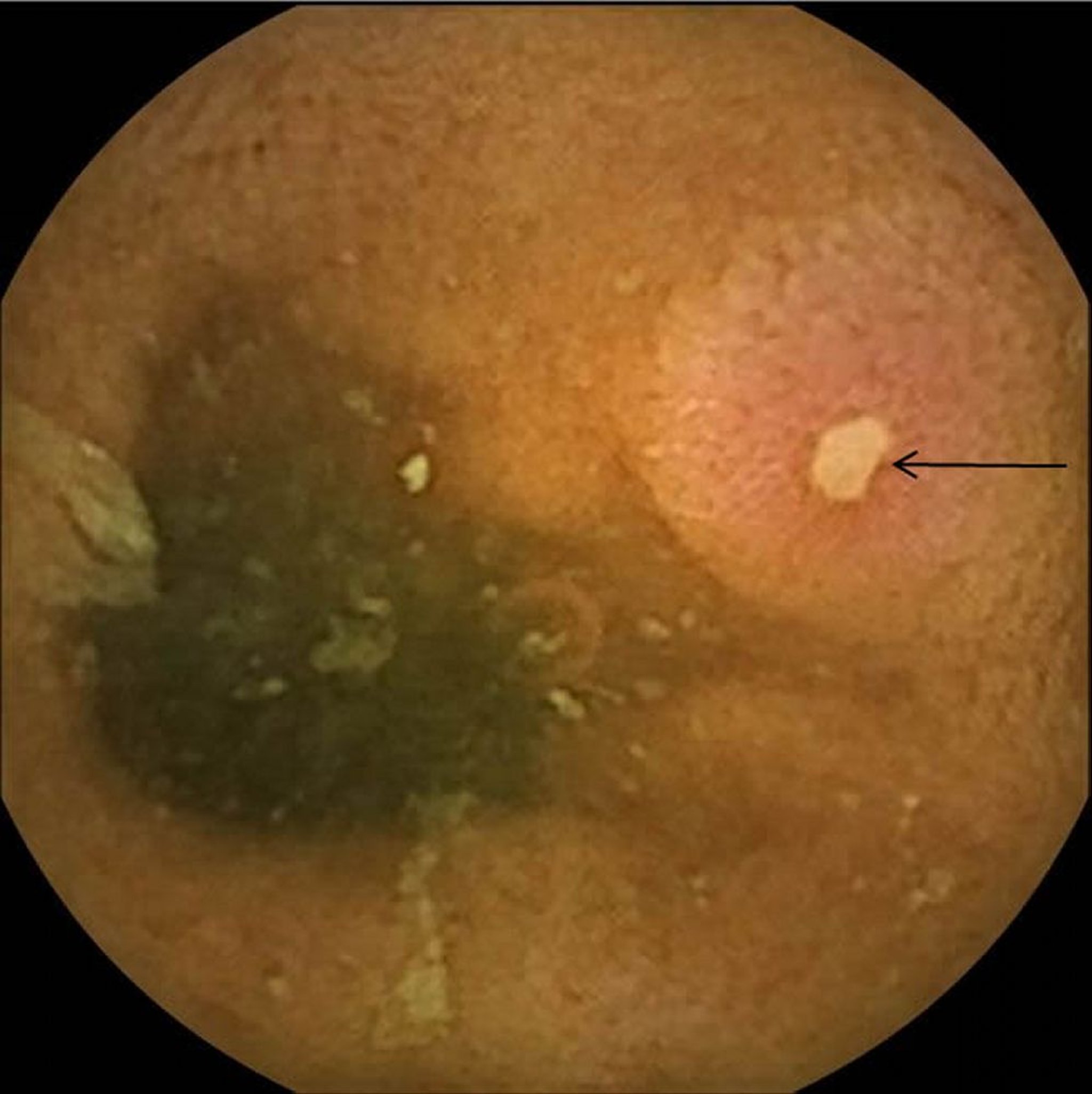 Ulkus des Ileums bei Morbus Crohn