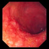 Viêm hồi tràng Crohn