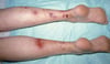 Cryoglobulinemia