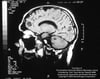 Cryptococcosis (Central Nervous System)