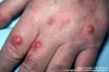 Cryptococcose (disséminée)