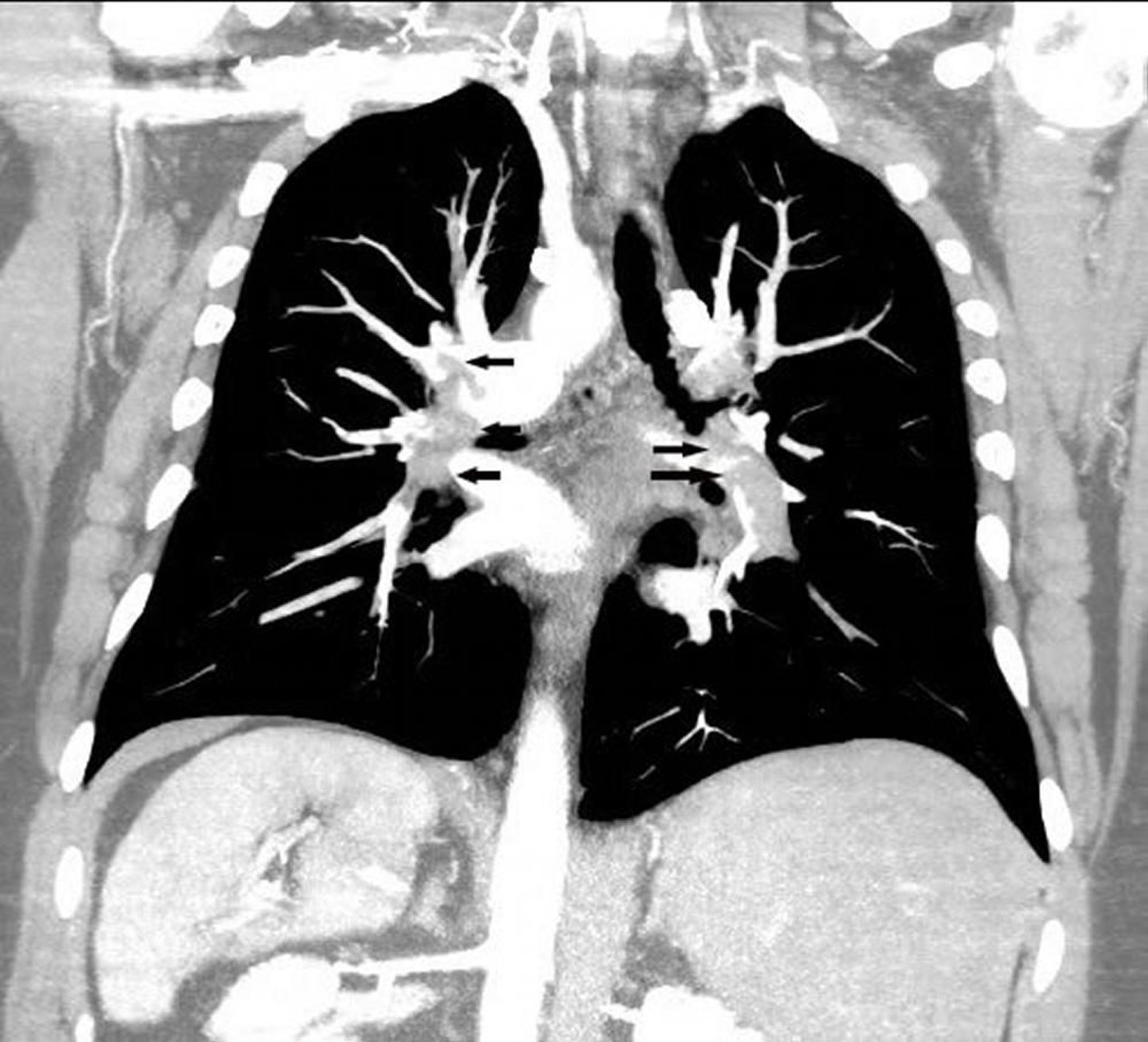 Angiographie pulmonaire par reconstruction TDM coronale
