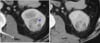 Contrast CT Scan of the Kidney (Corticomedullary and Nephrogenic Phases)