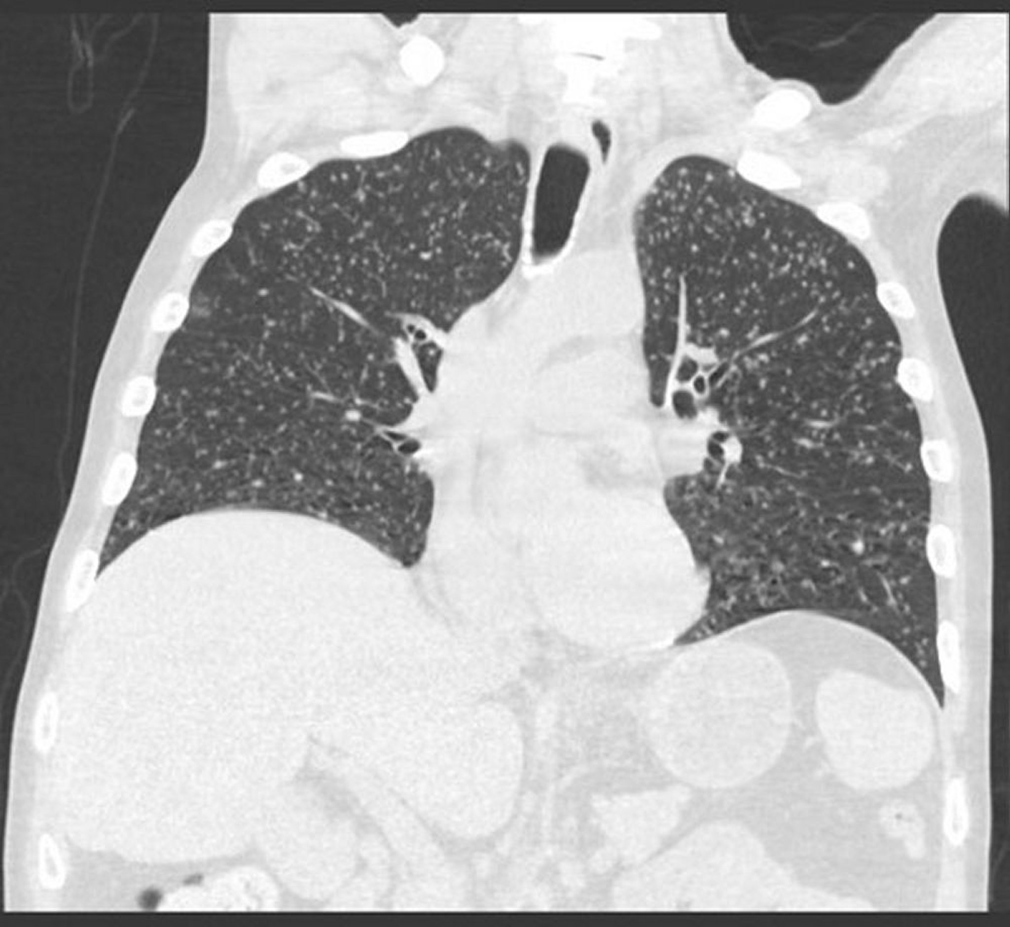 Enfermedad definitoria de sida: coccidioidomicosis