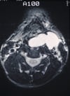 Laryngozele