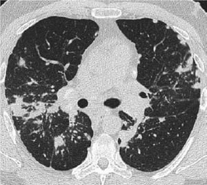 TC de tórax na sarcoidose pulmonar