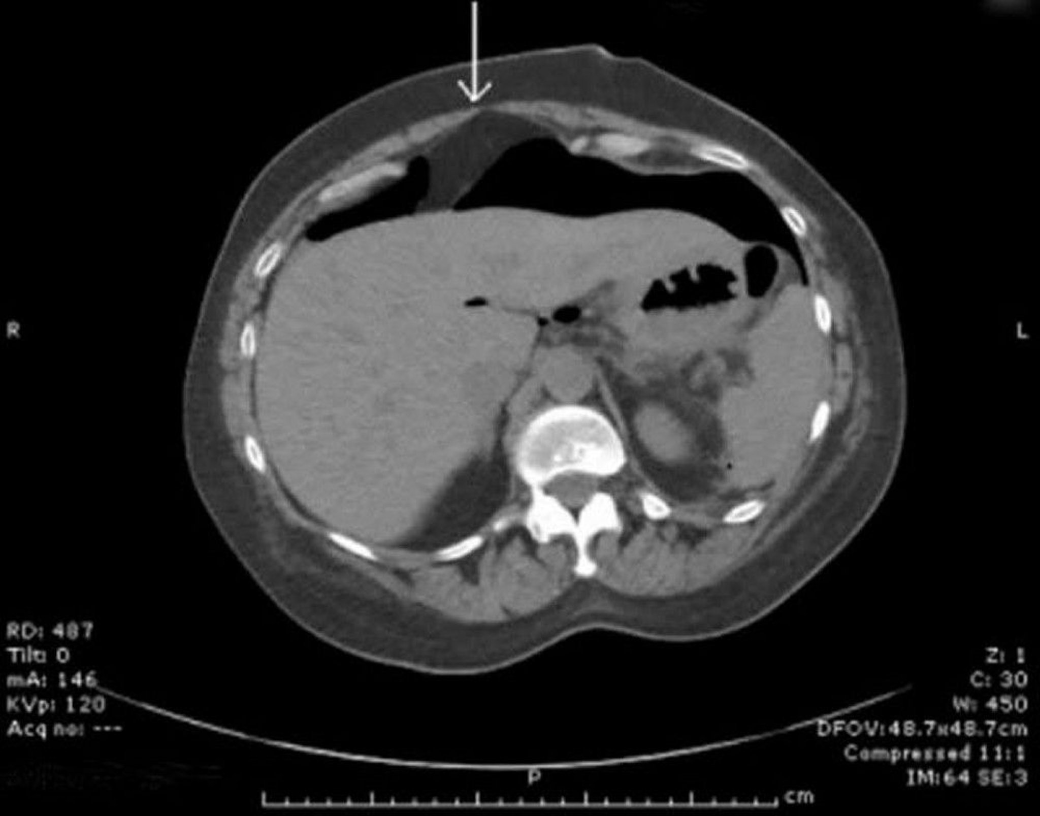 CT With Free Peritoneal Air