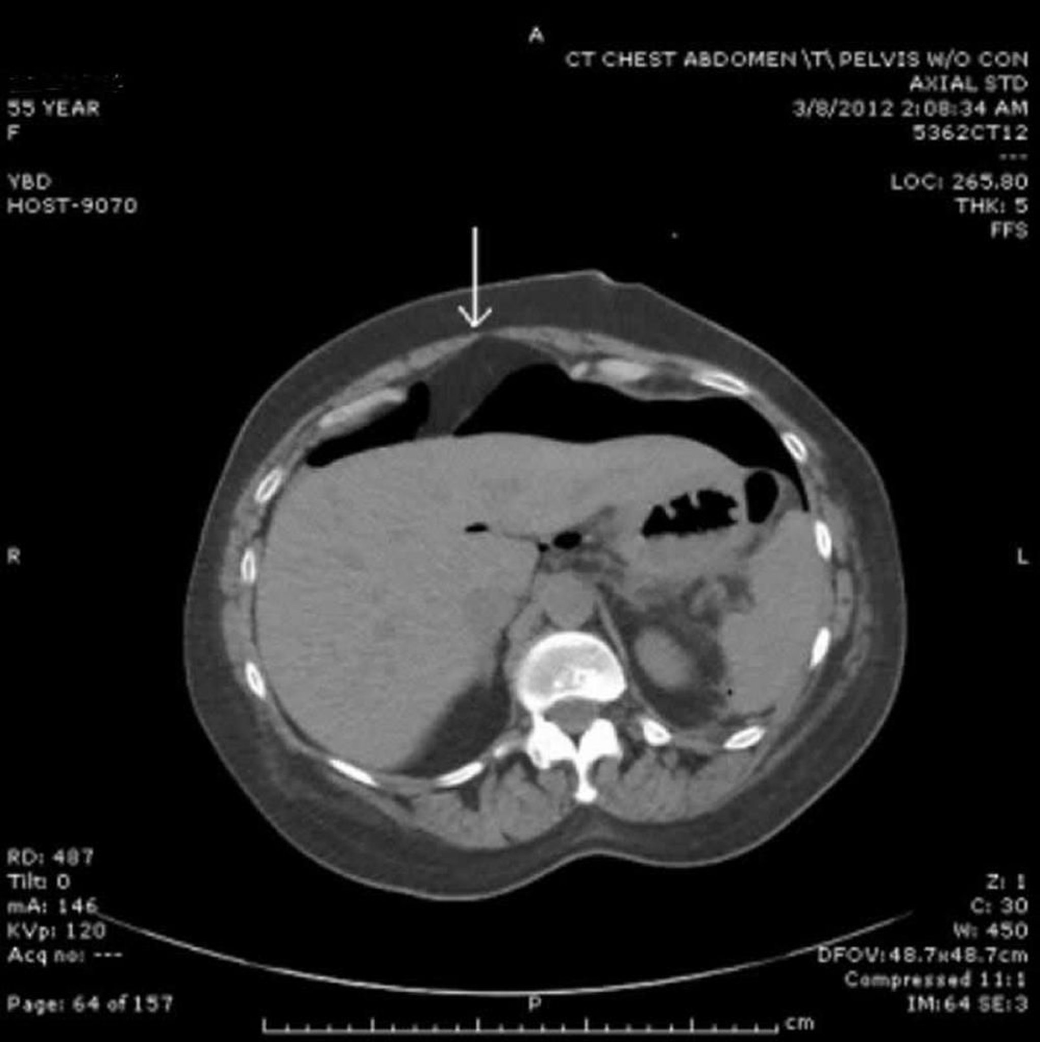 TC con aria libera nel peritoneo