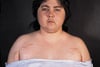 Cushing Syndrome