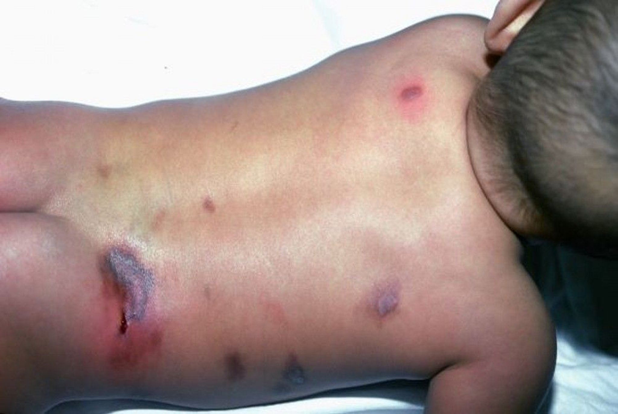 Cutaneous Mastocytosis (Back)