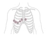 Right Ventricular (VR) Leads VR1 Through VR6