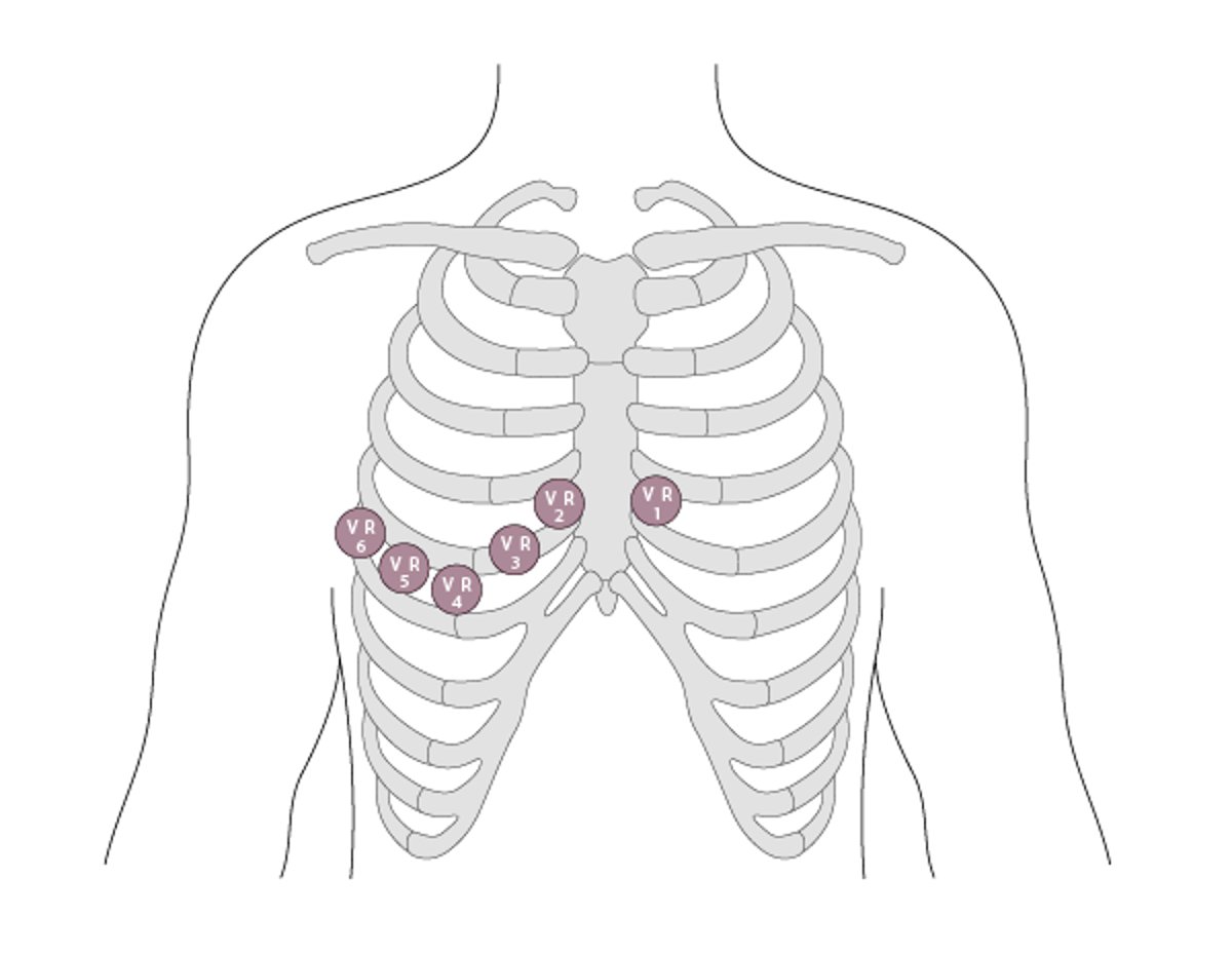 Rechtsventrikuläre (VR) Ableitungen VR1 bis VR6