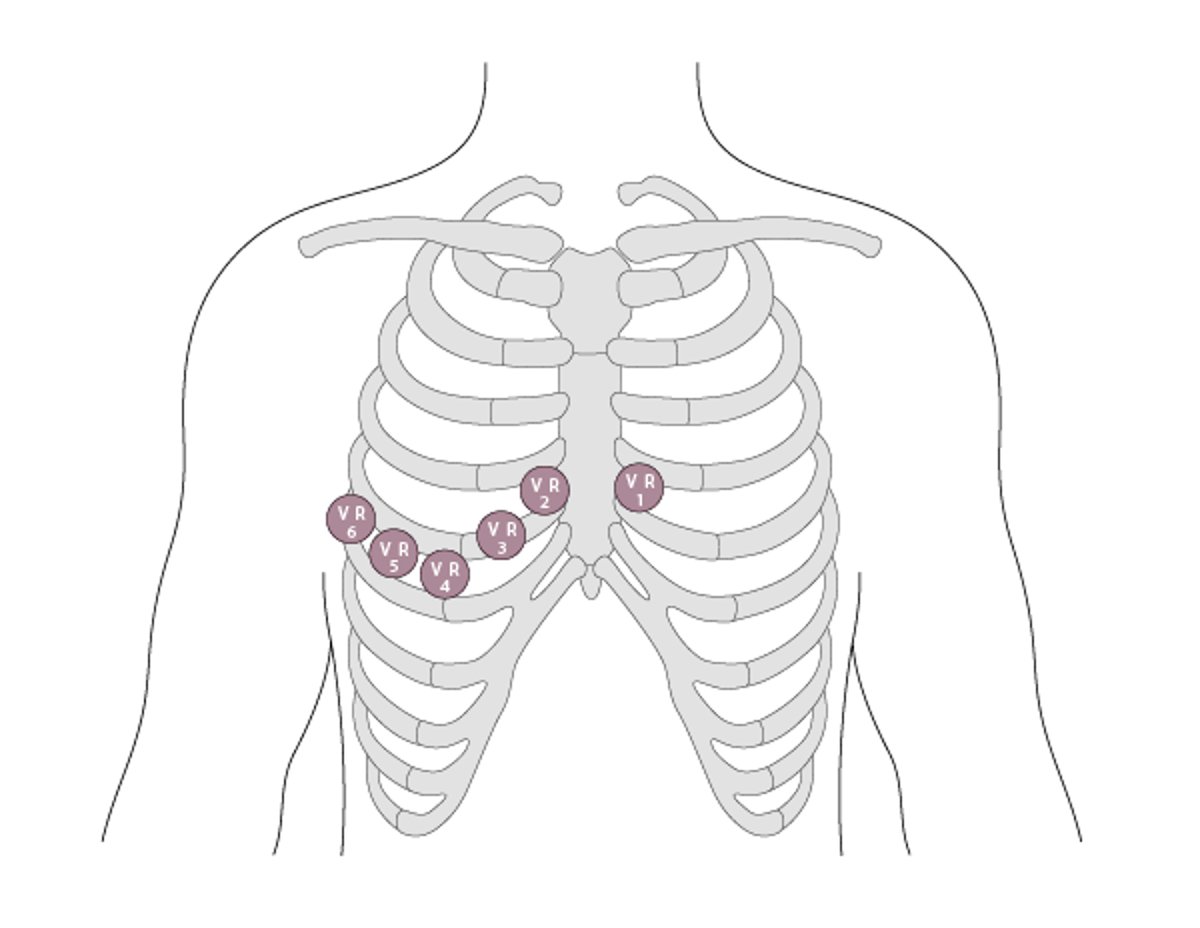 Right Ventricular (VR) Leads VR1 Through VR6