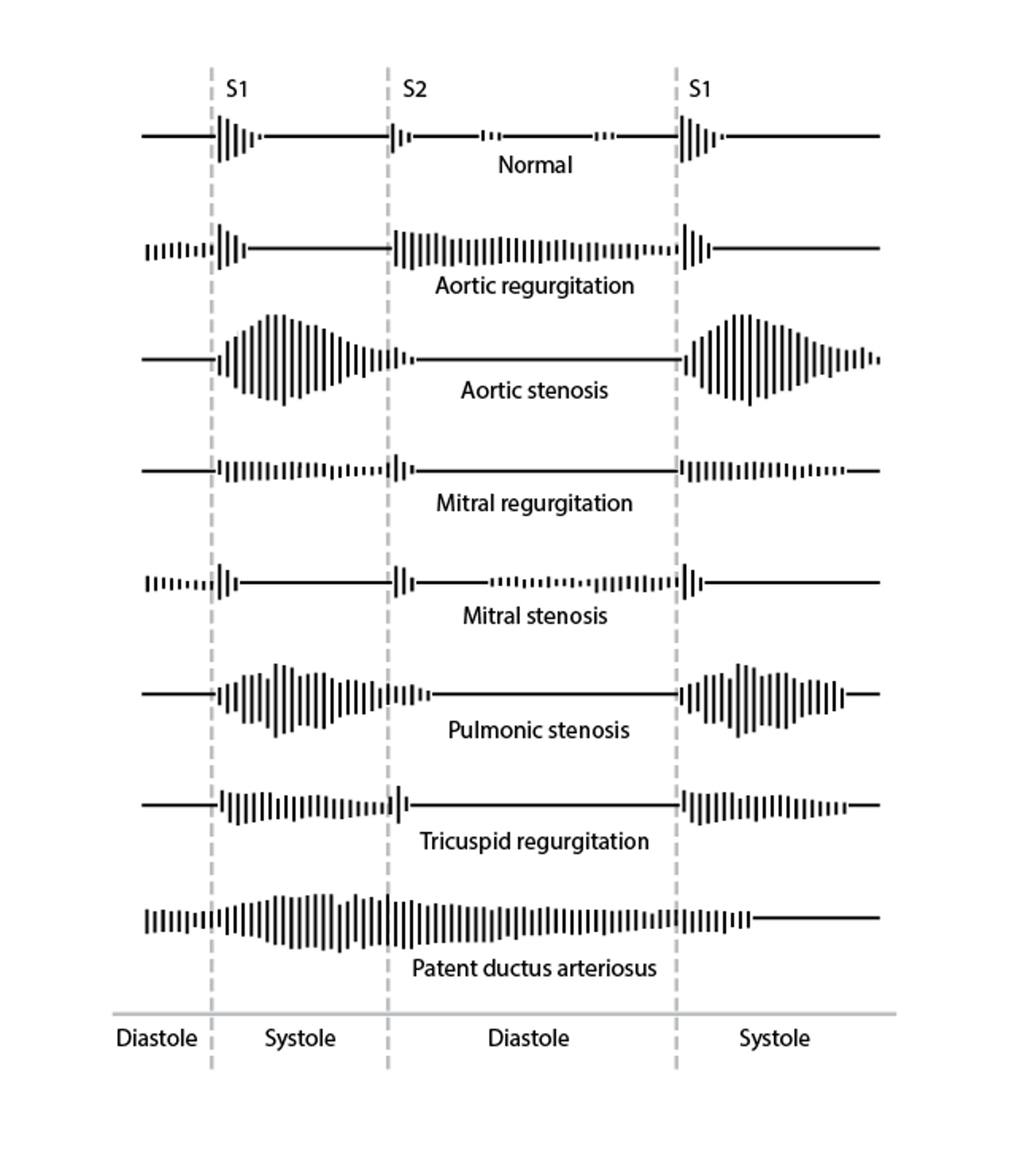 Phonocardiographic Characteristics of Heart Murmurs