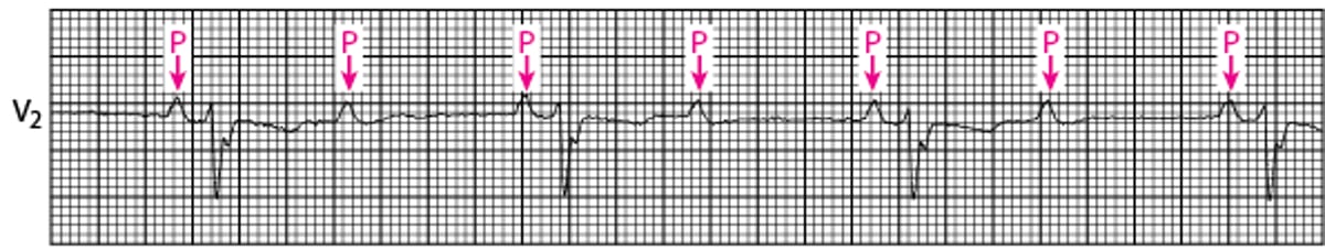 Second-Degree Atrioventricular Block (High Grade)