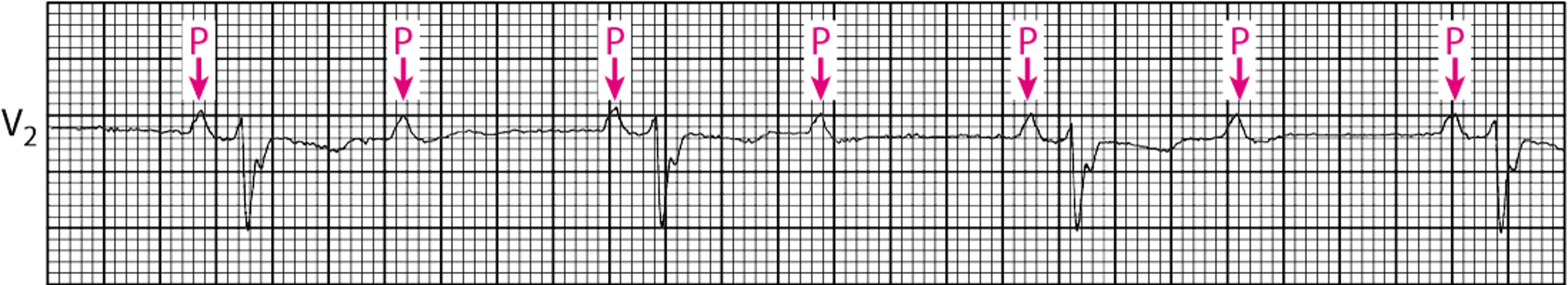 AV-Block II. Grades (hochgradig)