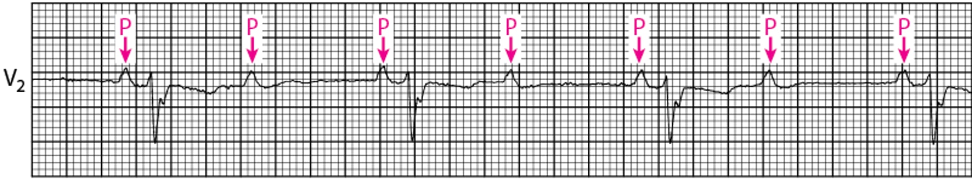 Bloqueo auriculoventricular de segundo grado (Alto grado)