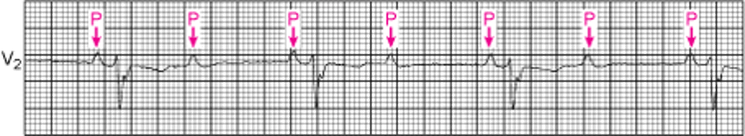 第2度房室ブロック（高度）