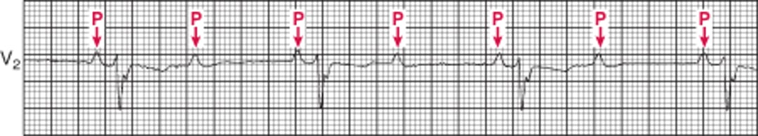 Block nhĩ thất cấp hai (cấp độ cao)