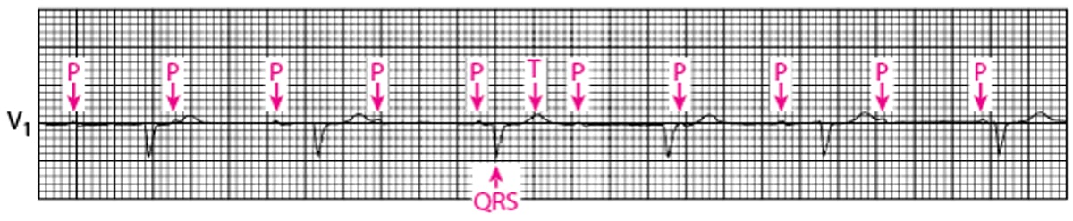 Third-Degree Atrioventricular Block