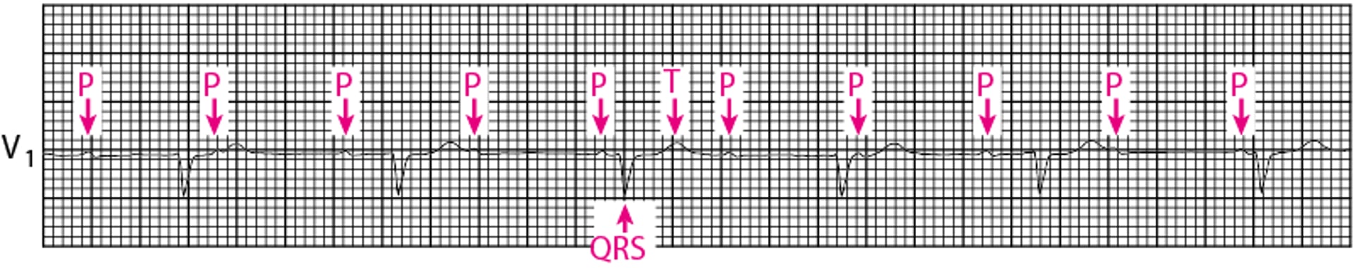Bloqueio atrioventricular de terceiro grau