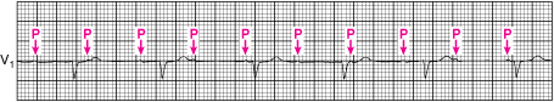 Атриовентрикулярная блокада III степени