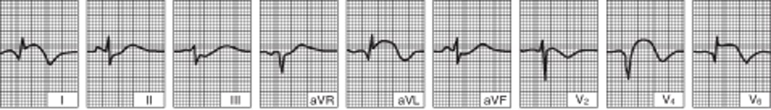 Lateral Left Ventricular Infarction (after the first 24 hours)