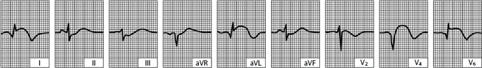 Infarctus latéral du ventricule gauche (après les 24 premières heures)