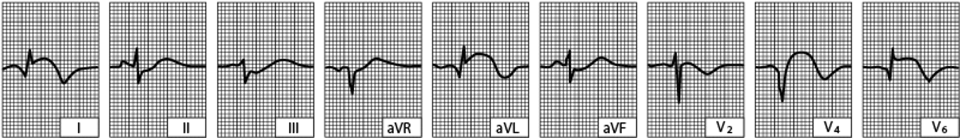 Infarto ventricular esquerdo lateral (após as primeiras 24 horas)