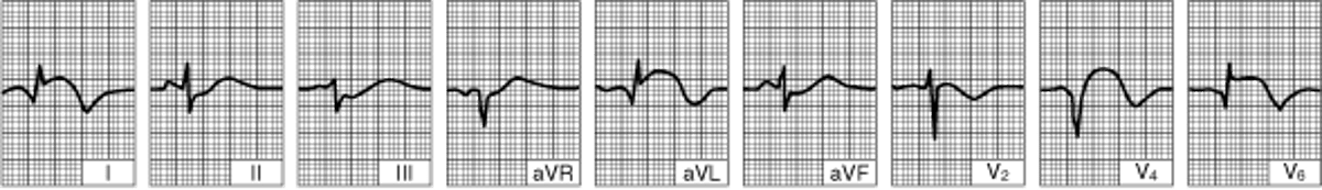 ИМ боковой стенки левого желудочка (через 24 часа с момента развития заболевания)