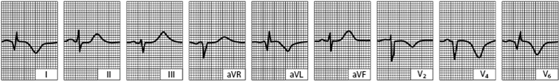Infarto laterale del ventricolo sinistro (molti giorni dopo)